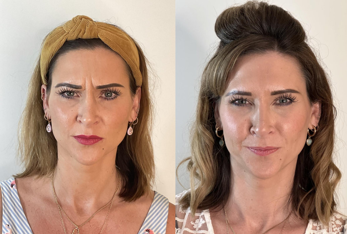 RefineAesthetics-B&A-AntiWrinkle