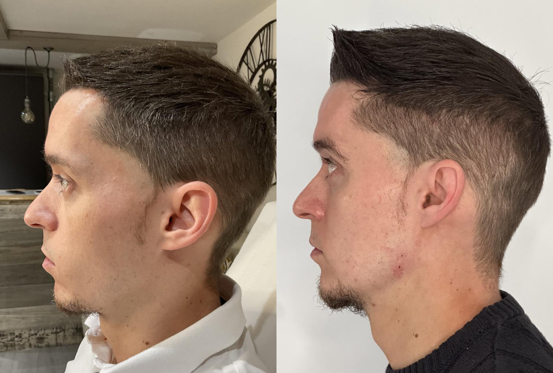 RefineAesthetics-B&A-DermalFillers1