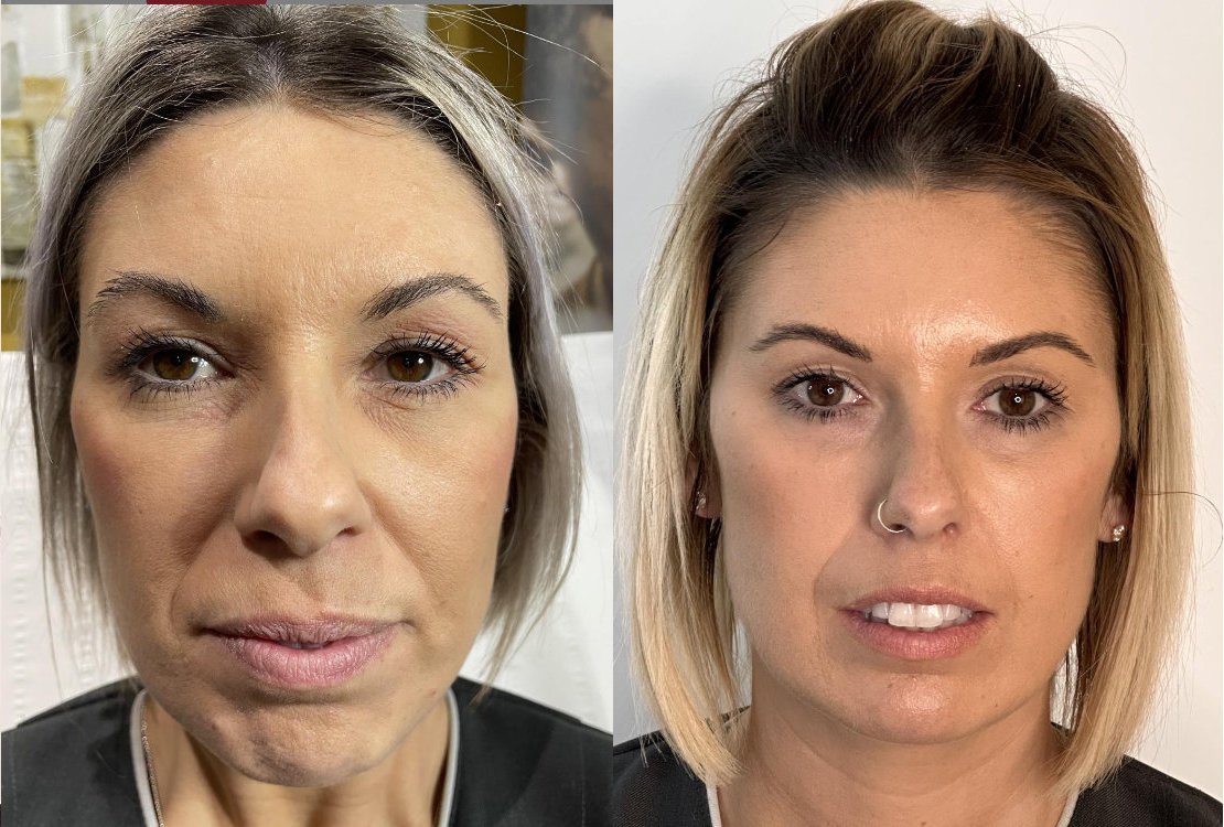 RefineAesthetics-B&A-DermalFillers3
