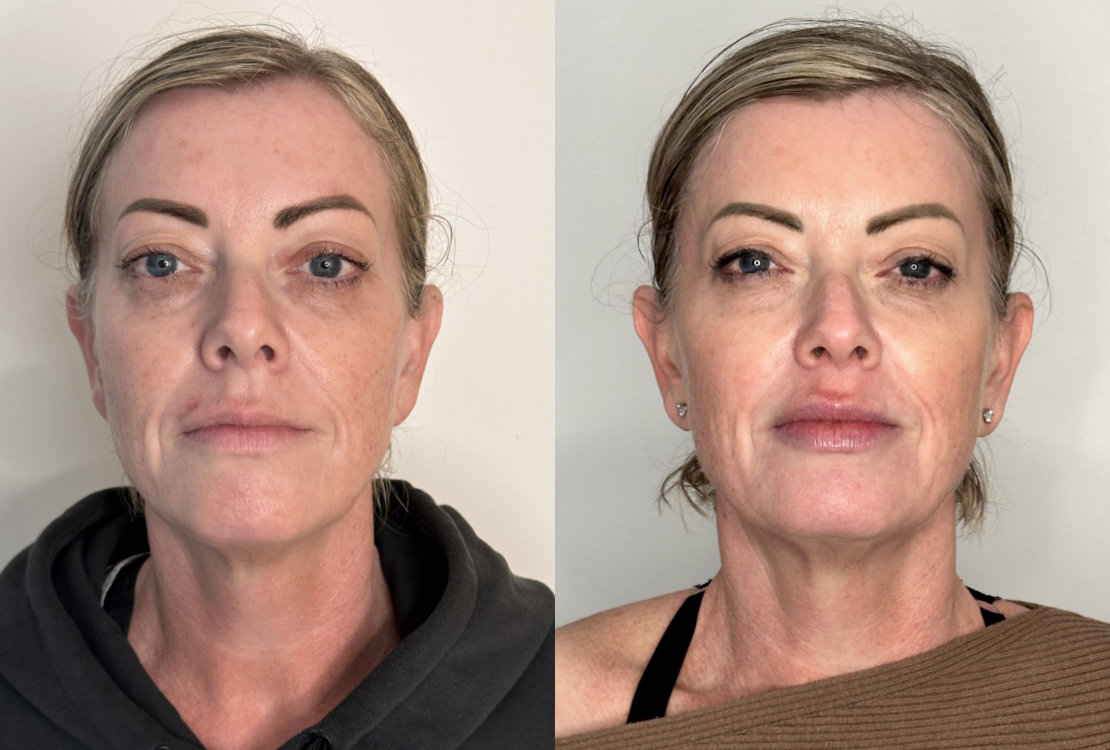 RefineAesthetics-B&A-Microneedling
