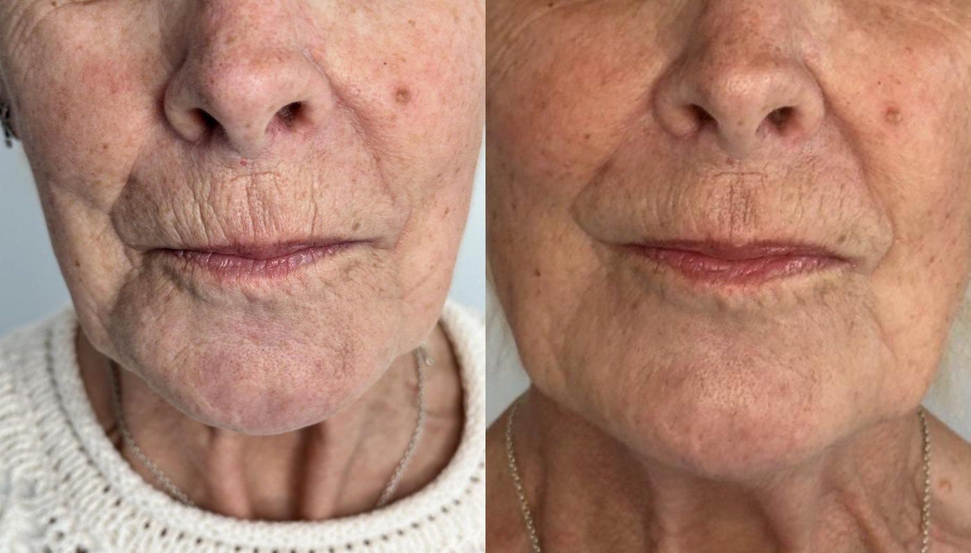 RefineAesthetics-B&A-Microneedling1