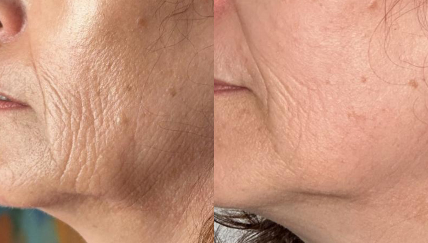 RefineAesthetics-B&A-Microneedling2