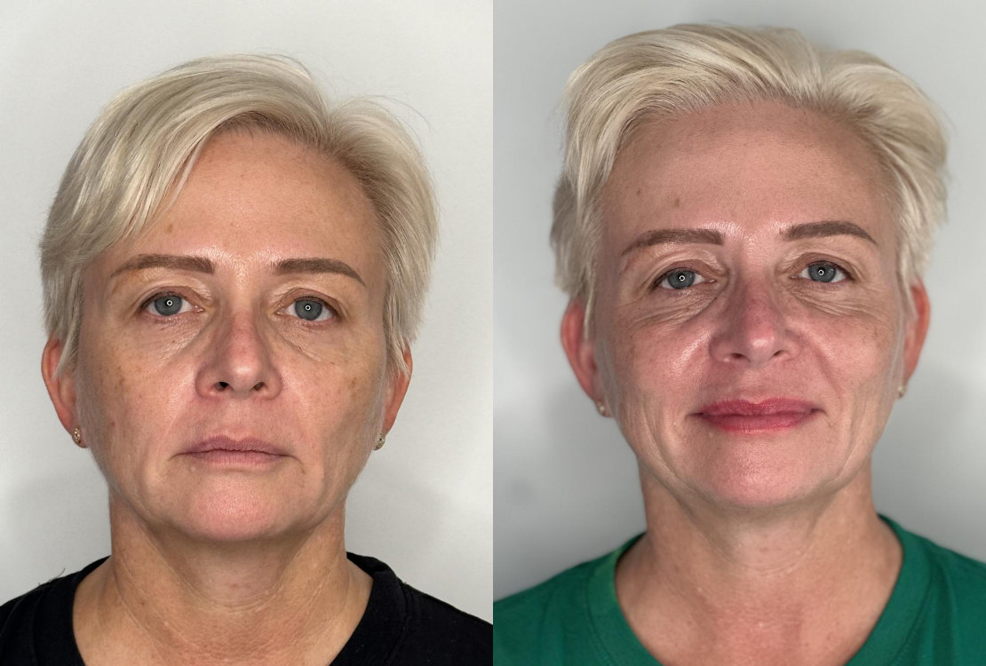 RefineAesthetics-B&A-Polynucleotide