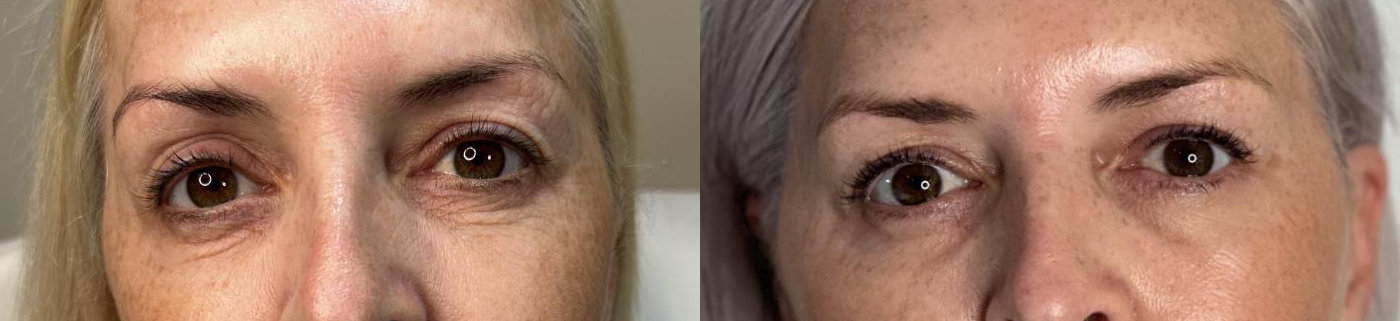 RefineAesthetics-B&A-Polynucleotide2