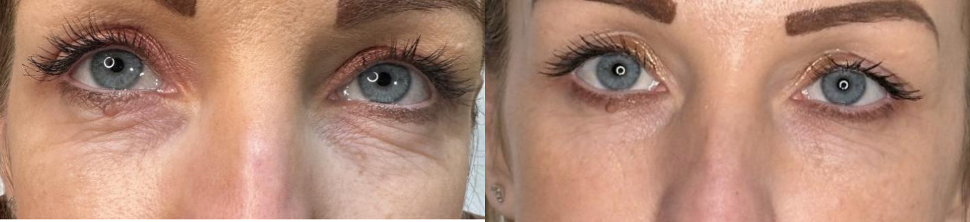 RefineAesthetics-B&A-Polynucleotide2