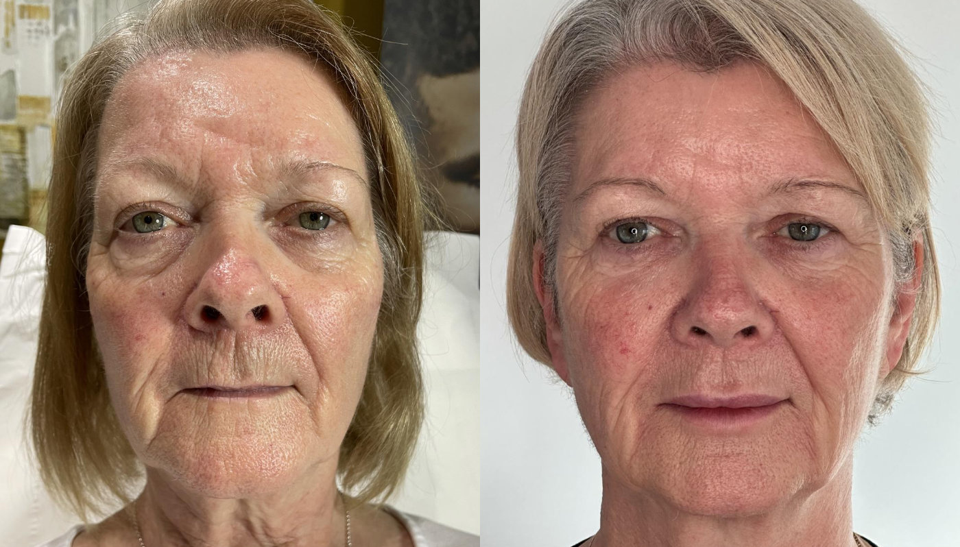 RefineAesthetics-B&A-Profhilo