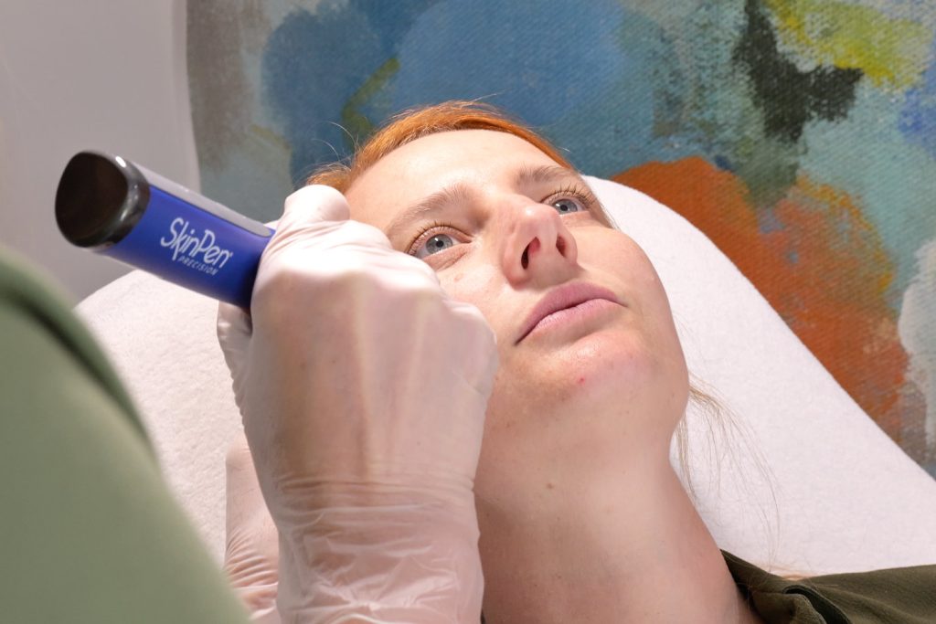 Refine Aesthetics Microneedling Treatments